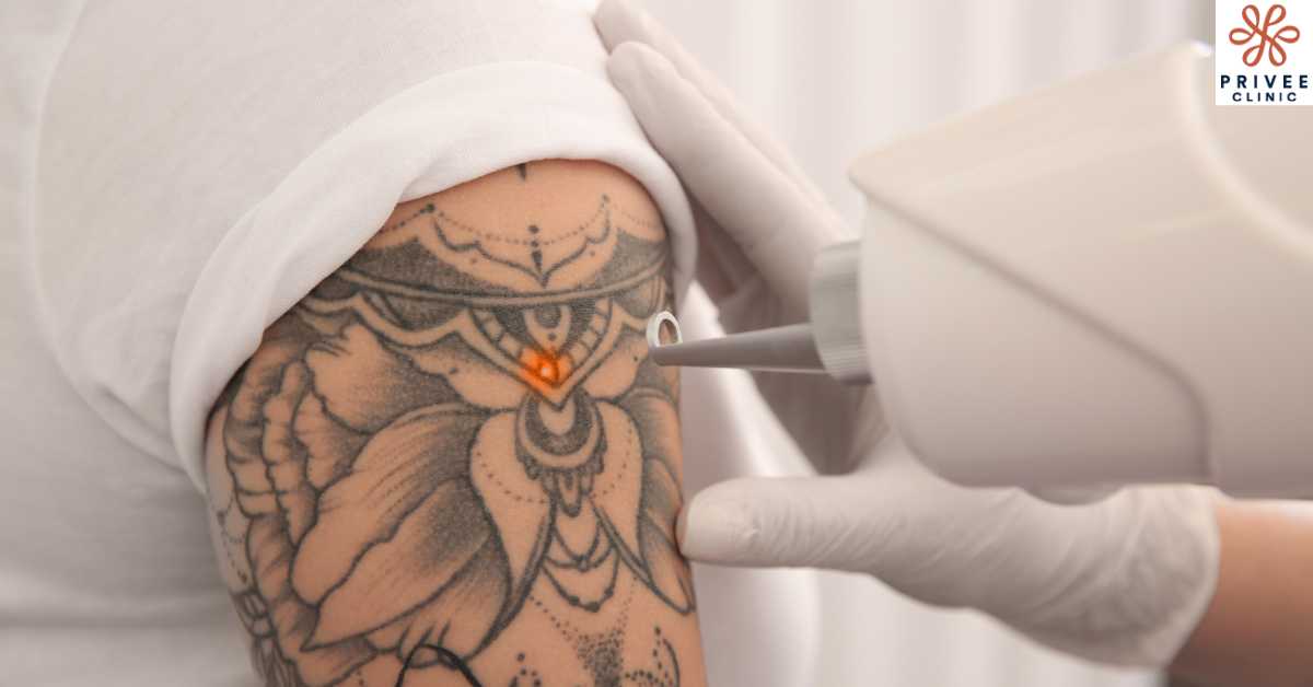 Jenis Laser dalam Tattoo Removal - Privee Clinic