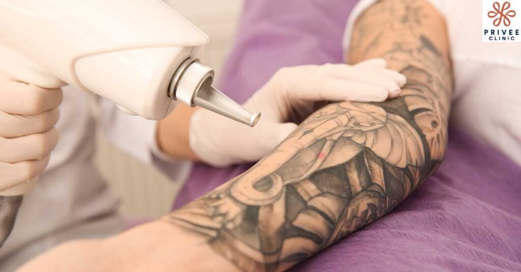 Panduan Lengkap Tattoo Removal Laser & Prosedurnya - Privee Clinic