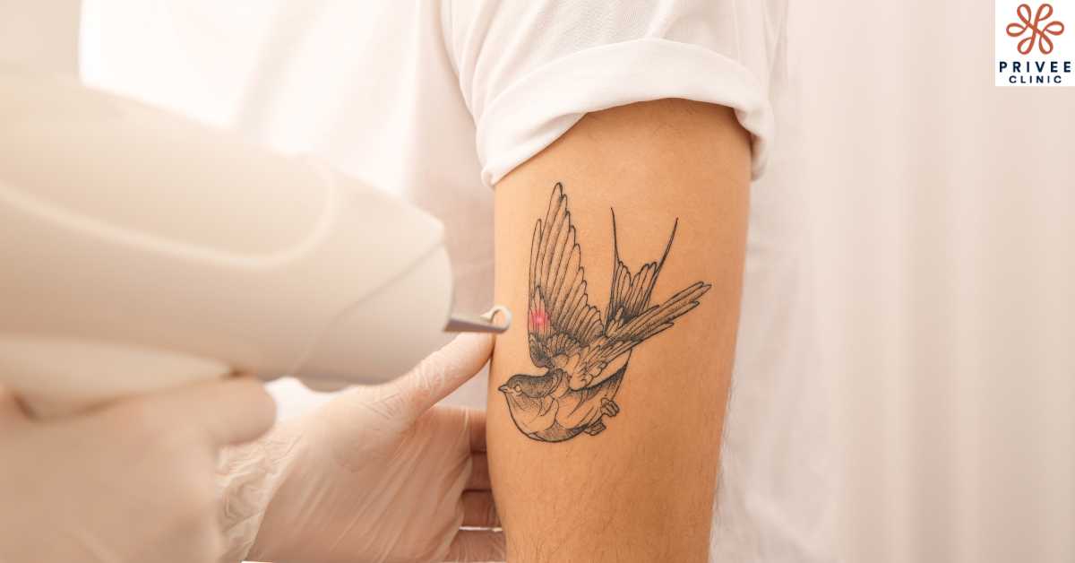 Perbandingan Metode Hapus Tato Laser vs. Cara Lama - Privee Clinic