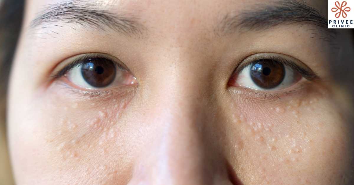 Apa Saja Penyebab Munculnya Milia? - Privee Clinic
