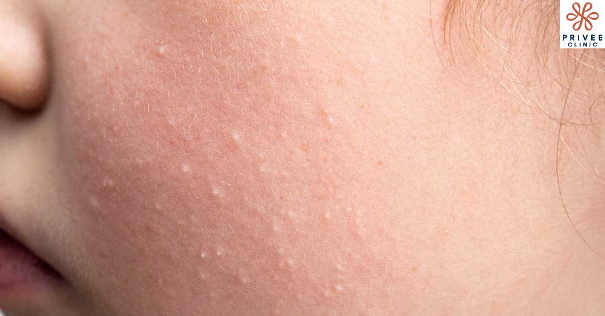 Pilihan Treatment Milia secara Profesional - Privee Clinic