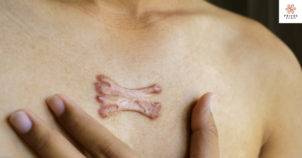 apakah keloid bisa hilang privee clinic