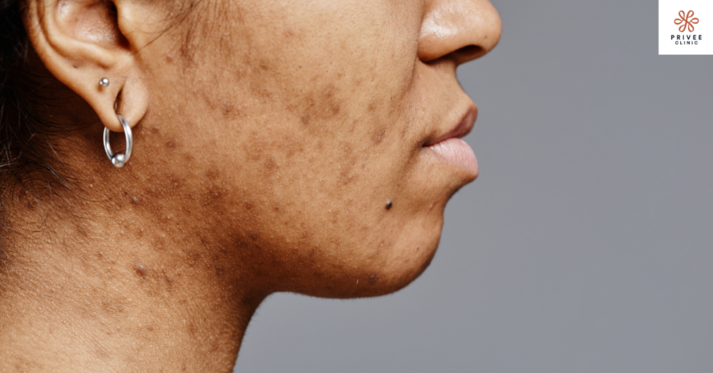 bekas luka jerawat hitam privee clinic