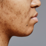 bekas luka jerawat hitam privee clinic