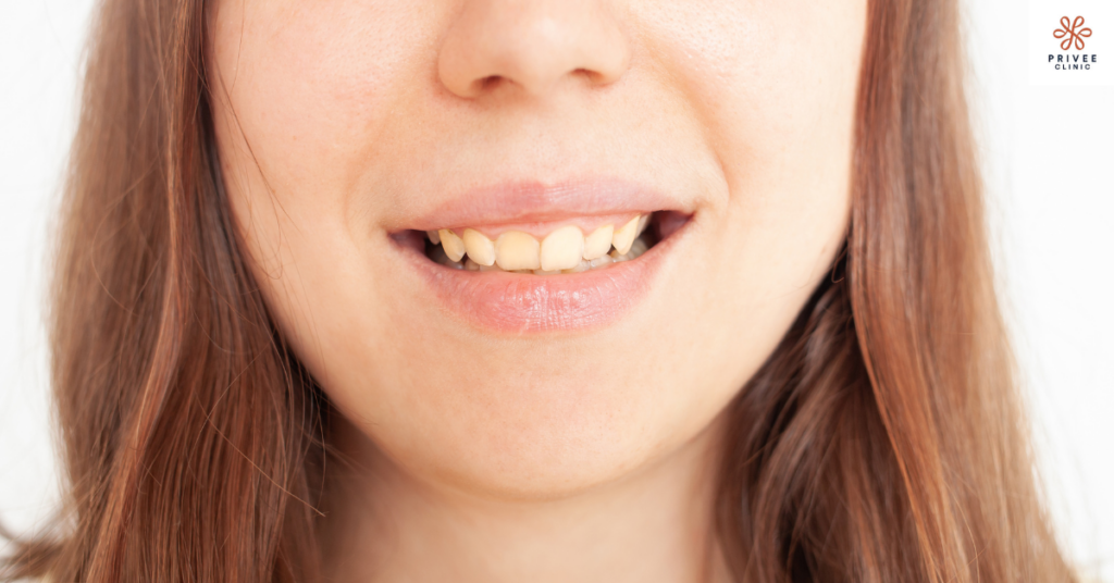 senyum miring crooked smile privee clinic