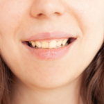 senyum miring crooked smile privee clinic