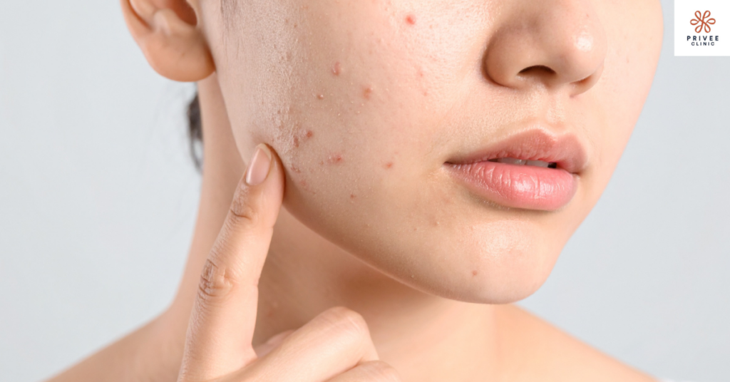 jerawat di pelipis privee clinic