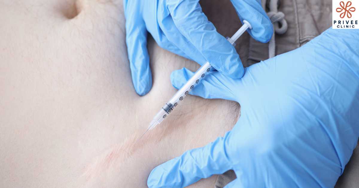 Berbagai Pilihan Keloid Treatment yang Perlu Anda Tahu - Privee Clinic