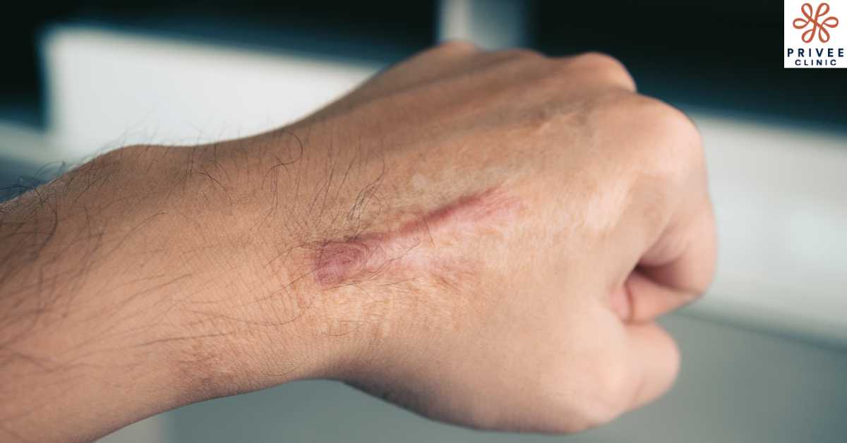 Penyebab dan Faktor Risiko Munculnya Keloid - Privee Clinic