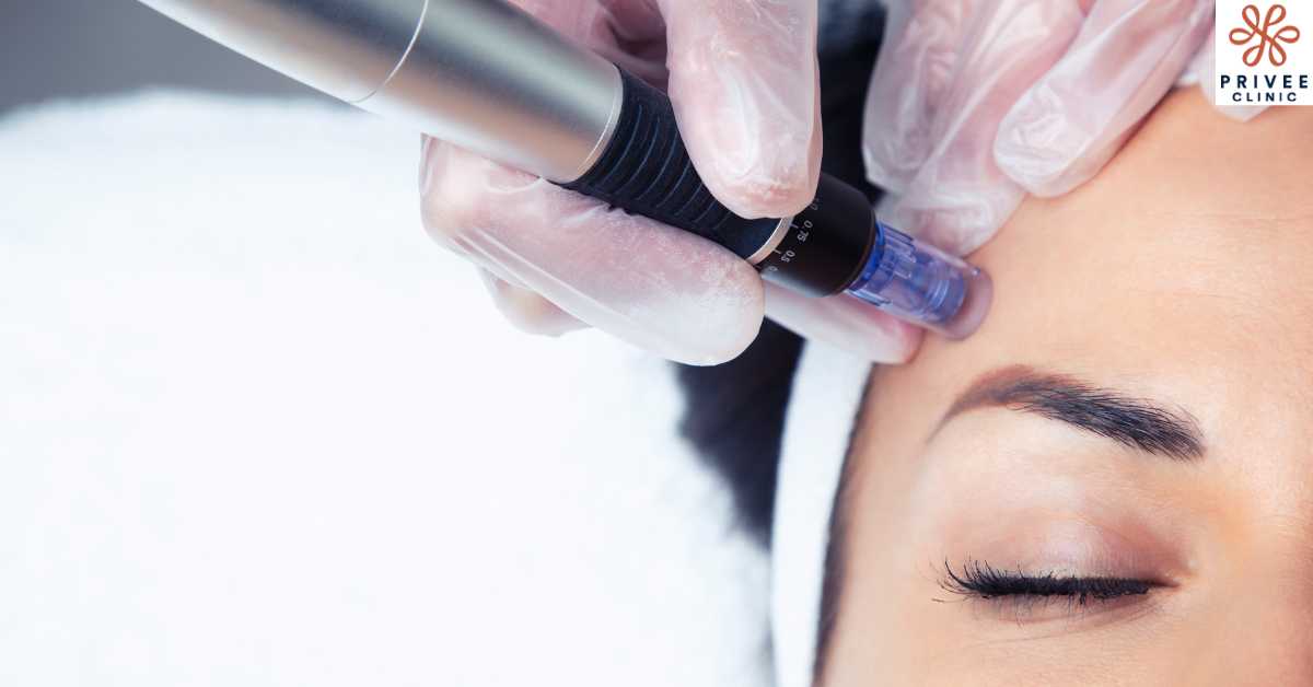 Apa Itu Microneedling - Privee Clinic