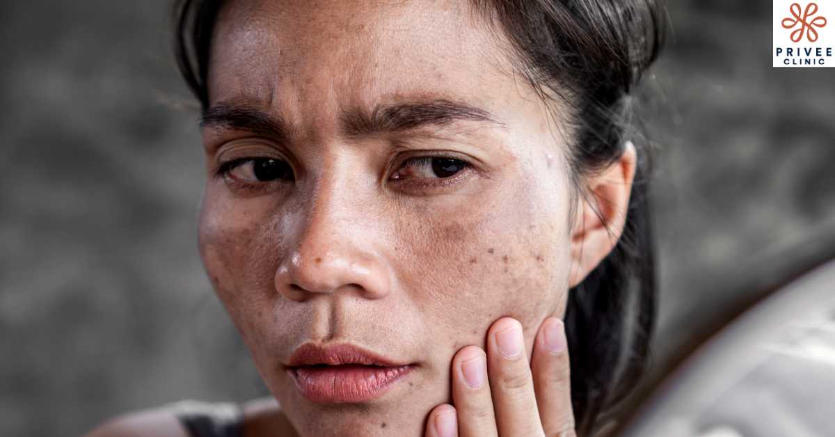Mengapa Flek Hitam Sulit Hilang - Privee Clinic