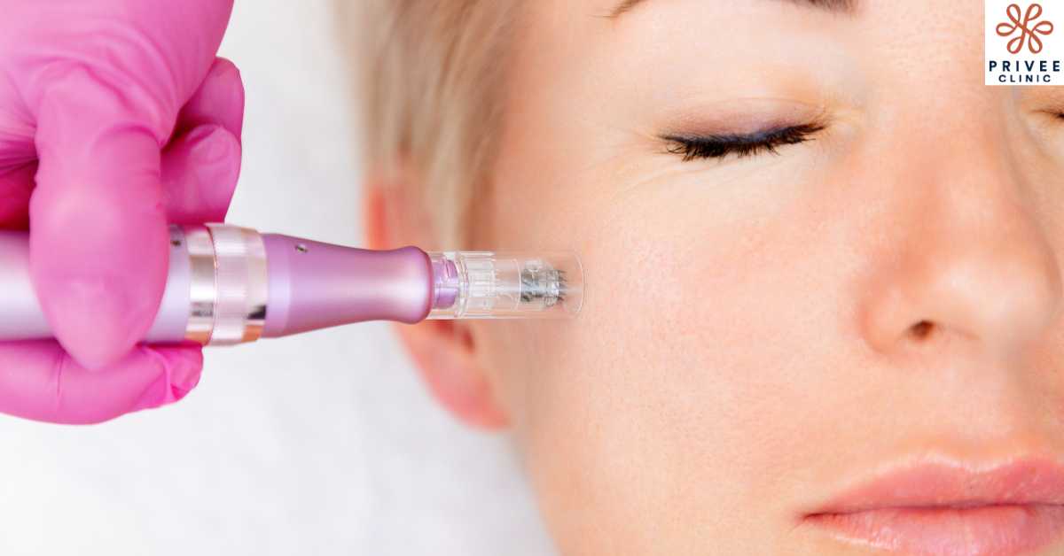 Mengapa Mengombinasikan Microneedling dengan Exosome - Privee Clinic