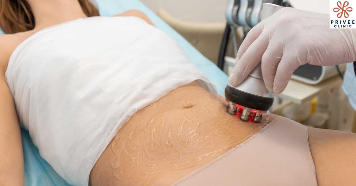 Apa Itu RF (Radio Frequency) - Privee Clinic