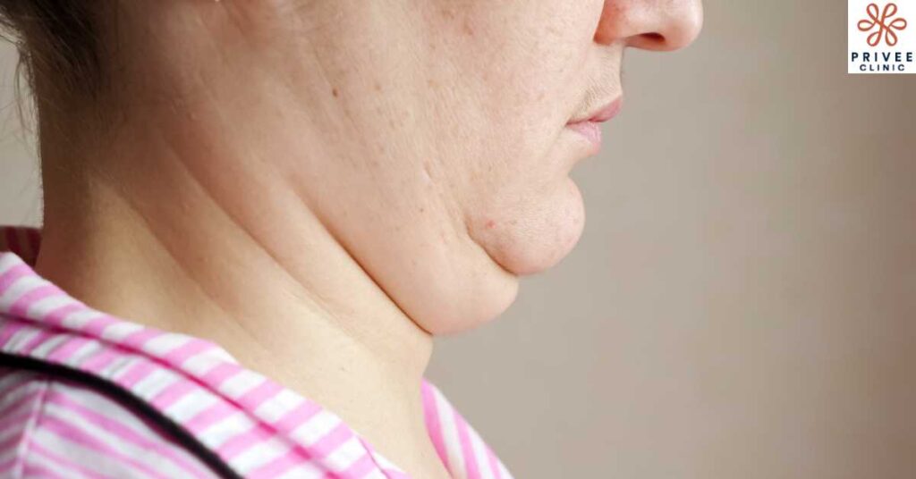 Bye-Bye Dagu Berlipat Cara Menghilangkan Double Chin! - Privee Clinic