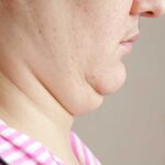 Bye-Bye Dagu Berlipat Cara Menghilangkan Double Chin! - Privee Clinic