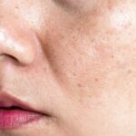 cara menghilangkan flek hitam wajah Privee Clinic