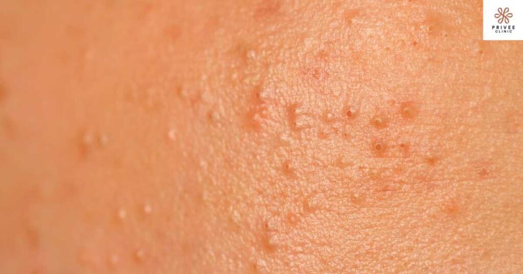 fungal acne Privee Clinic