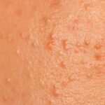 fungal acne Privee Clinic