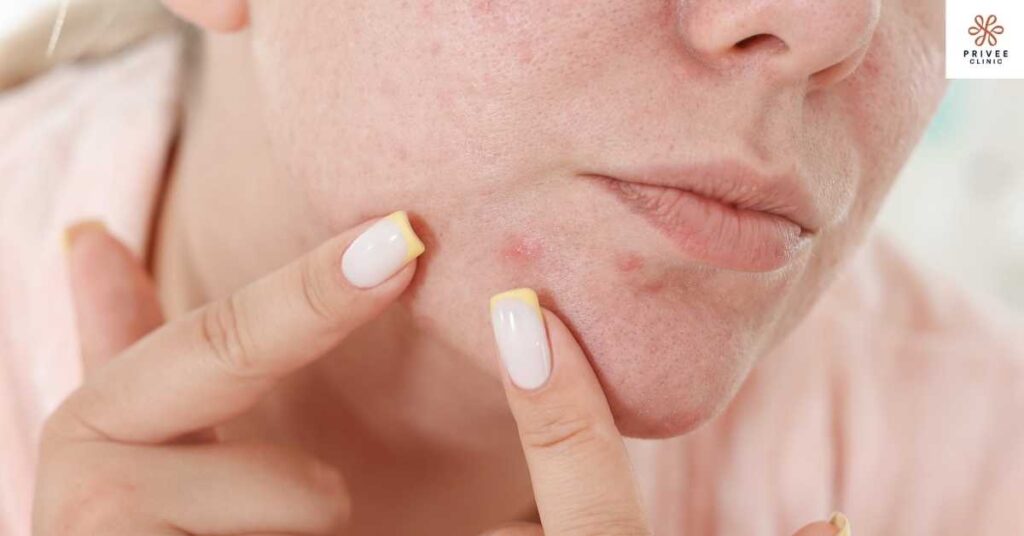 jerawat mendem Privee Clinic