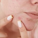 jerawat mendem Privee Clinic