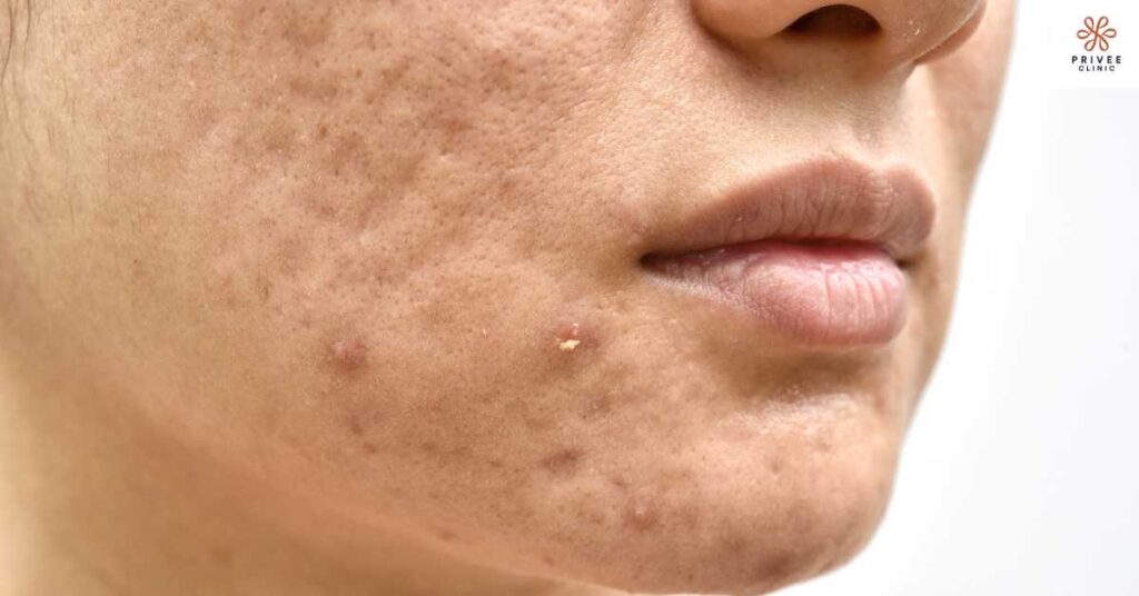 kulit wajah bertekstur Privee Clinic