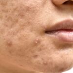 kulit wajah bertekstur Privee Clinic