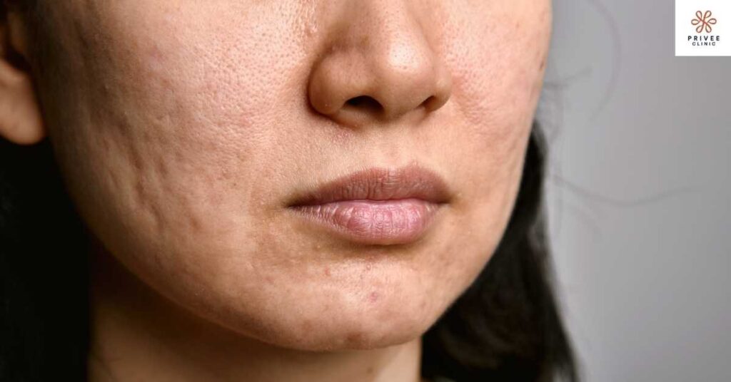 penyebab bopeng Privee Clinic