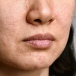 penyebab bopeng Privee Clinic