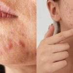 perbedaan purging dan breakout Privee Clinic