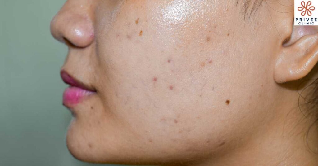 Atasi Flek Hitam Membandel dengan Peeling Wajah - Privee Clinic