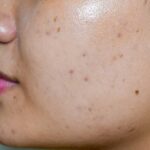 Atasi Flek Hitam Membandel dengan Peeling Wajah - Privee Clinic